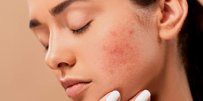 Cómo reducir el acne con estos remedios naturales