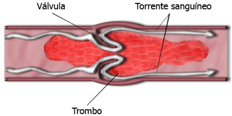 trombosis venosa profunda